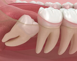 Fototapeta Kosmos - Abnormal position of wisdom teeth. Medically accurate tooth 3D illustration