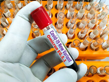 Blood Sample For Covid-19 Omicron EG.5.1 (Eris) Test. A New Covid-19 Variant Which Has Descended From The Rapidly Spreading In The UK And India.