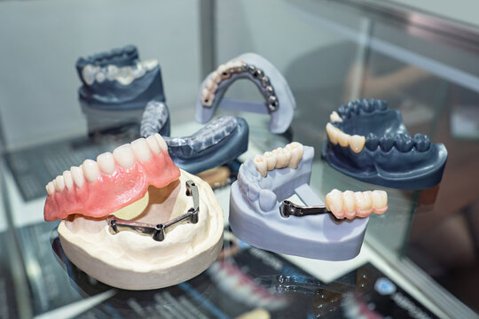 Dental implants. Dentist design set. Models of dentures. Implants for experiments of orthodonists. Prosthetics and dental treatment. Dental technician table. Visual aid with metal fasteners for teeth