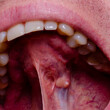 A tumor in the oral cavity of an adult, close-up. dental problems.