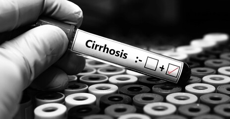 Wall Mural - Blood sample of patient positive test for cirrhosis.