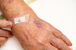 Close up old woman hand, upper limb or arm to the wounded waiting for nurse treatment on wound dressing a bloody and brine of patient on white background.