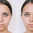 © Марина Демешко - Young caucasian woman's face with drooping upper eyelid before and after blepharoplasty on a light background. Result of plastic surgery. Changing the shape, cut of the eyes. Difference, comparison