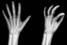 X-ray Of The Hands, Detail Of The Phalanges And Joints,trapeze,scaphoid,Pyramidal,Pisiform,capitate, Distal, Frontal, Proximal, Interflaginian, Lunate, Intercapitate