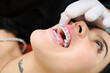 © J Esteban Berrío/Stocksy - Close up of a patient with braces