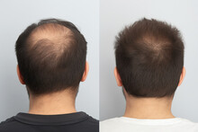The Head Of A Balding Man Before And After Hair Transplant Surgery. Hair Loss Treatment. 