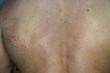 © R R/Wirestock Creators - Man suffering from the skin condition Tinea Versicolor with discolored patches on the skin