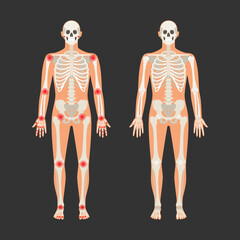 Human skeleton with pain points in rheumatoid arthritis. Men anatomy illustration with a body silhouette. Vector isolated flat of skull and bones in body