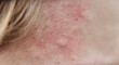 © Евгений Вершинин - Bite mark, sting or sore on human skin. Close up of symptoms. Healthcare theme.