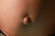Large congenital umbilical hernia protruding from anterior abdominal wall in Asian. It is an abnormal bulge that can be seen at the umbilicus (belly button).