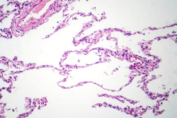 Wall Mural - Diffuse emphysema, light micrograph