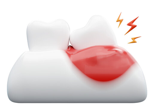 gingival hyperplasia with teeth