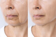 © Марина Демешко - Lower part of elderly woman's face and neck with signs of skin aging before after facelift, plastic surgery. Age-related changes, flabby sagging skin, wrinkles, creases. Rejuvenating procedures