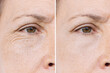Elderly caucasian woman's face with facial wrinkles near eyes before and after injection with fillers. Result of injection cosmetology. Correction of wrinkles with hyaluronic acid preparations
