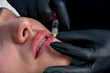 © Edgar1 BJ - closeup to the lips of a young woman who is being injected with hyaluronic acid