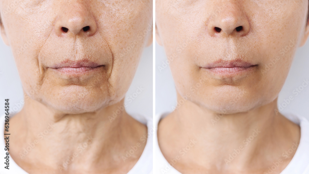 Lower part of face and neck of a caucasian elderly woman with signs of ...
