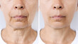 Lower part of face and neck of a caucasian elderly woman with signs of skin aging before after facelift, plastic surgery. Age-related changes, flabby saggy skin, wrinkles, creases. Rejuvenation