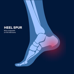 Wall Mural - Heel spur poster