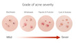 © piyaset - Grade of acne severity