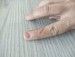 Cut finger close up. Finger wound.