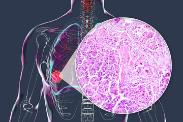 Poster - Lung cancer, 3D illustration and light micrograph