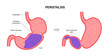 Gastroparesis anatomical poster