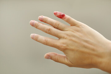 Female hand with red blood, little finger is bleeding profusely. Woman injured her little finger at home with knife or other sharp object. Bleeding wound and body injury result. Domestic accident.