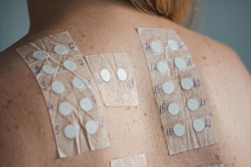 patch test on the naked shoulder and back of a young blonde hair girl. allergy patch testing is used