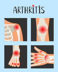 Joints of the human skeleton with pain red dots. Rheumatoid arthritis vector illustration about inflammation