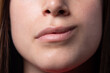 Close-up of the mouth of a girl with hemiparesis, Bell's palsy