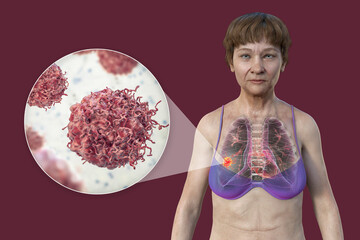 Canvas Print - A woman with lung cancer, and close-up view of cancer cells, 3D illustration