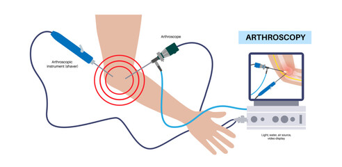 Poster - Elbow arthroscopy surgery