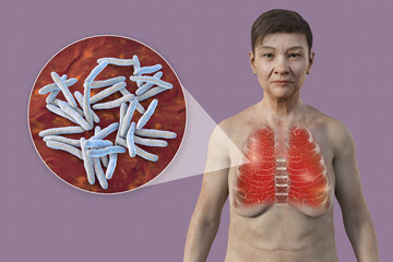 Poster - A female patient with lungs affected by miliary tuberculosis and close-up view of Mycobacterium tuberculosis bacteria, 3D illustration