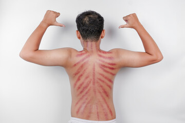 Wall Mural - Red marks from scrapes coin on a man's back. Kerokan is a way of traditional Javanese culture medical treatment to treat symptoms of colds in Indonesia