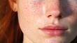 Close-Up of Young Woman's Face Showing Rosacea Couperose Redness and Spots on Cheeks - A Dermatological Skin Problem Causing Suffering