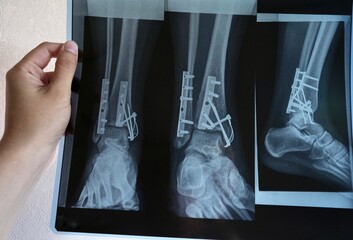 X-ray, a picture of the leg bones after surgery in the hands of a doctor