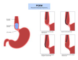 Poster - POEM medical poster