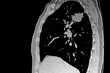 X Ray: lateral view of lung tumor.