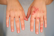 Patient hands with and without eczema comparison. Dermatitis, atopic skin.