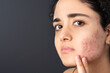 Acne on the young girl's face. Acne in teenage girl