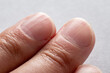 Macro photo of vertical ridges in fingernails
