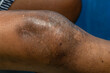 Man with purulent arthritis scar on right knee. Medical themes