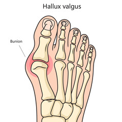 Wall Mural - Hallux valgus bunion structure vertebral column diagram schematic vector illustration. Medical science educational illustration