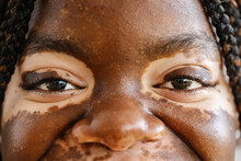 Close-up View Shot Of Young Adult African Woman Eyes With Vitiligo Skin. Diversity And People Concept