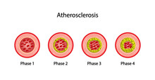 Atherosclerosis, normal artery versus narrowed artery blocked with cholesterol plaque. Blood vessel blocked with a clot. High cholesterol level as atherosclerotic risk. ldl and hdl. Vector design