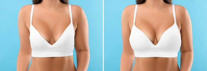 Poster - Woman before and after breast augmentation on light blue background, closeup. Collage with photos showing difference between breast sizes