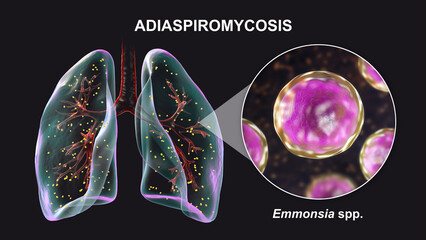 Poster - Lung adiaspiromycosis and close-up view of Emmonsia fungi, 3D illustration