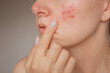© Ольга Шефер - close-up photo of a young Caucasian woman suffering from the skin chronic disease rosacea on her face in the acute stage. Pink acne. Dermatological problems.  isolated on a beige background