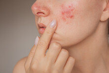 Close-up Photo Of A Young Caucasian Woman Suffering From The Skin Chronic Disease Rosacea On Her Face In The Acute Stage. Pink Acne. Dermatological Problems.  Isolated On A Beige Background