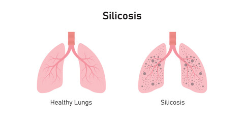 Wall Mural - Silicosis Pulmonary Fibrosis Concept Design. Vector Illustration.